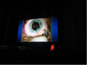 European Society of Cataract & Refractive Surgeons Mohammed Muhtaseb iLase Wales